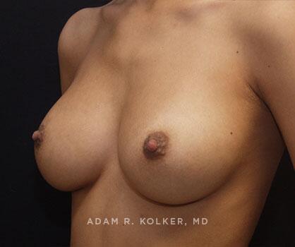 Inverted Nipple Correction After Image Patient 01 Oblique View