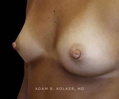 Inverted Nipple Correction After Image Patient 02 Oblique View