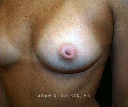 Inverted Nipple Correction Before Image Patient 02 Side View