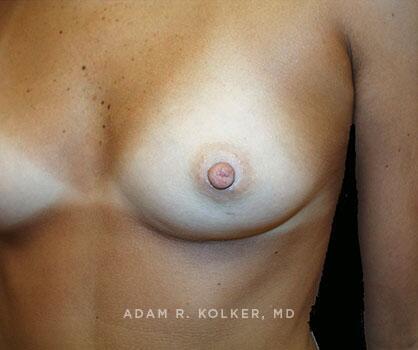Inverted Nipple Correction After Image Patient 02 Side View
