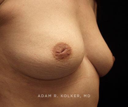 Inverted Nipple Correction Before Image Patient 05 Oblique View