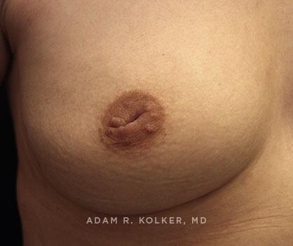 Inverted Nipple Correction Before Image Patient 05 Side View