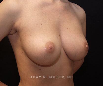 Inverted Nipple Correction After Image Patient 06 Oblique View