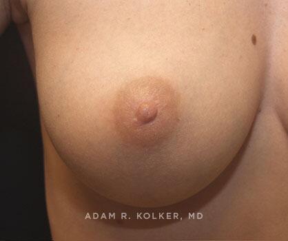 Inverted Nipple Correction After Image Patient 06 Side View