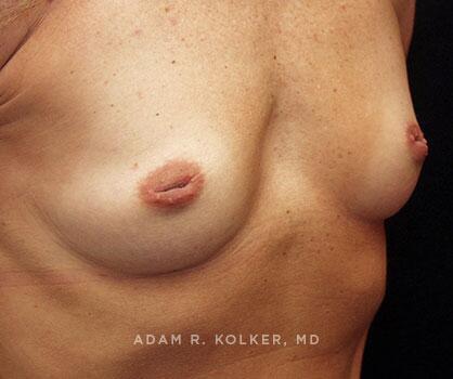 Inverted Nipple Correction Before Image Patient 07 Oblique View