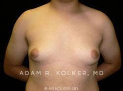 Gynecomastia Surgery Before Image Patient 03 Front View