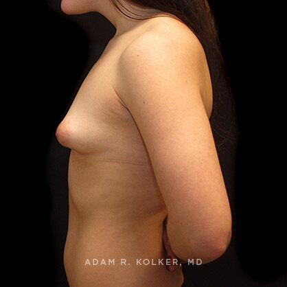 Tuberous Breast Correction Before Image Patient 01 Side View