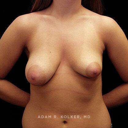 Tuberous Breast Correction Before Image Patient 03 Front View