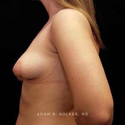Tuberous Breast Correction Before Image Patient 03 Side View