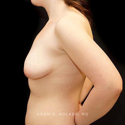 Tuberous Breast Correction Before Image Patient 07 Side View