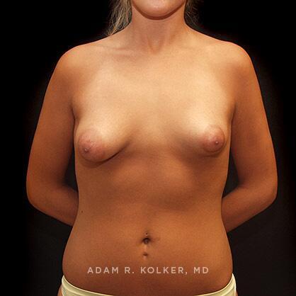 Tuberous Breast Correction Before Image Patient 09 Front View