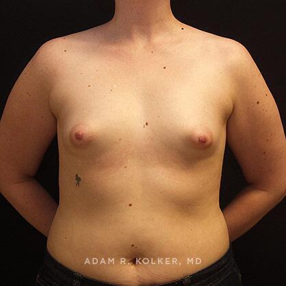 Tuberous Breast Correction Before Image Patient 12 Front View