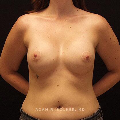Tuberous Breast Correction After Image Patient 12 Front View