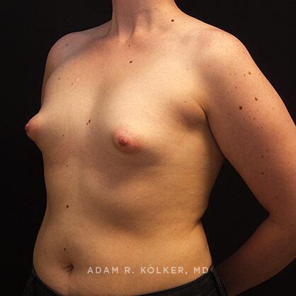 Tuberous Breast Correction Before Image Patient 12 Oblique View