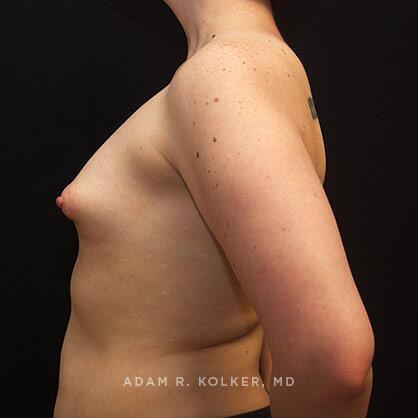 Tuberous Breast Correction Before Image Patient 12 Side View