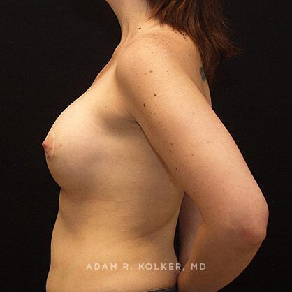 Tuberous Breast Correction After Image Patient 12 Side View