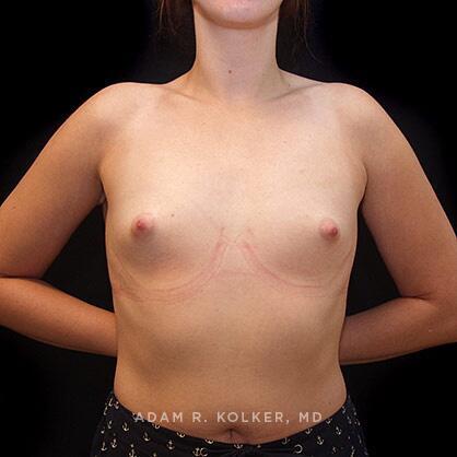 Tuberous Breast Correction Before Image Patient 13 Front View