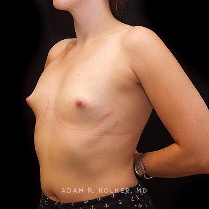 Tuberous Breast Correction Before Image Patient 13 Oblique View