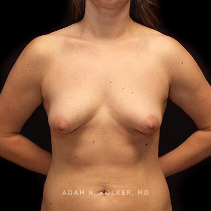 Tuberous Breast Correction Before Image Patient 14 Front View