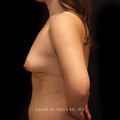Tuberous Breast Correction Before Image Patient 14 Side View