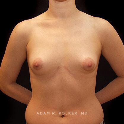 Tuberous Breast Correction Before Image Patient 15 Front View