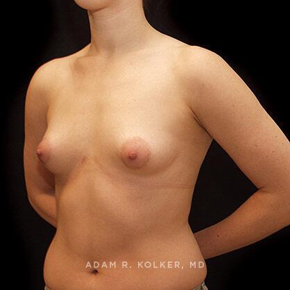 Tuberous Breast Correction Before Image Patient 15 Oblique View