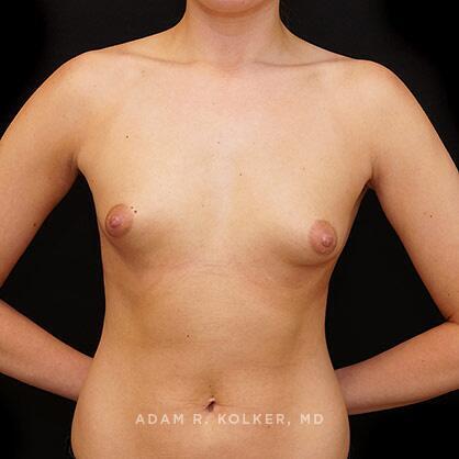 Tuberous Breast Correction Before Image Patient 16 Front View