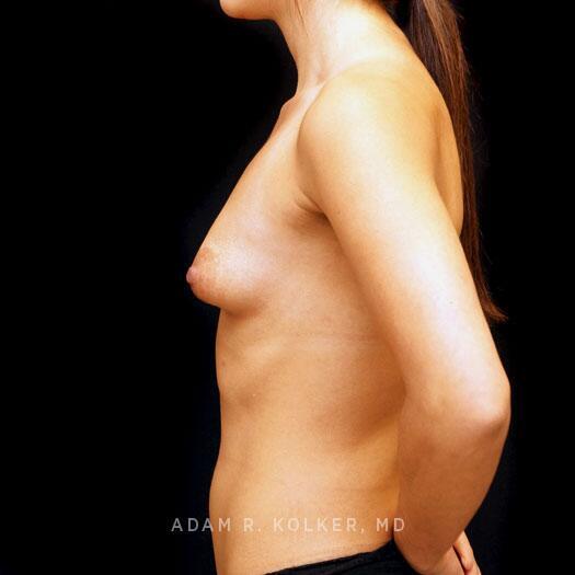 Tuberous Breast Correction Before Image Patient 17 Side View