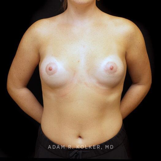 Tuberous Breast Correction After Image Patient 19 Front View