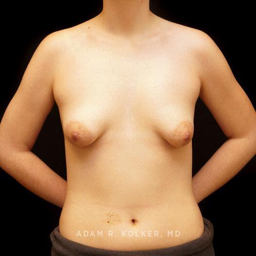 Tuberous Breast Correction Before Image Patient 20 Front View