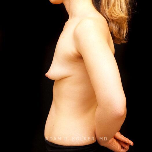 Tuberous Breast Correction Before Image Patient 23 Side View