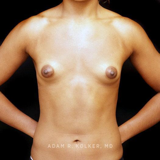 Tuberous Breast Correction Before Image Patient 25 Front View