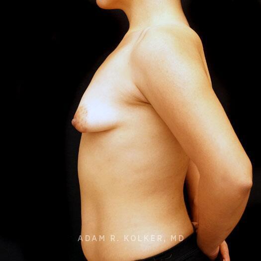 Tuberous Breast Correction Before Image Patient 27 Side View