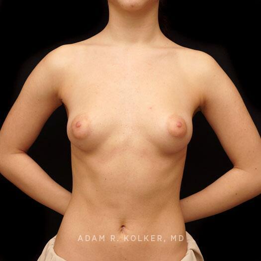 Tuberous Breast Correction Before Image Patient 28 Front View