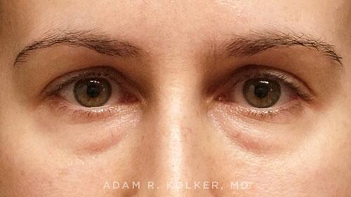 Blepharoplasty Before Image Patient 03 Front View