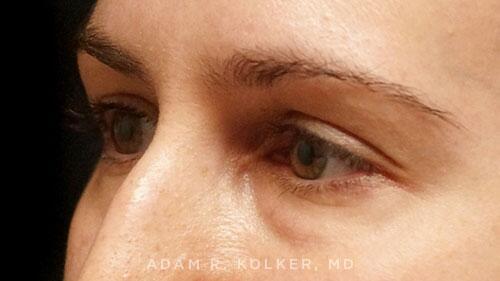 Blepharoplasty Before Image Patient 03 Oblique View