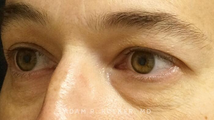 Blepharoplasty Before Image Patient 04 Oblique View