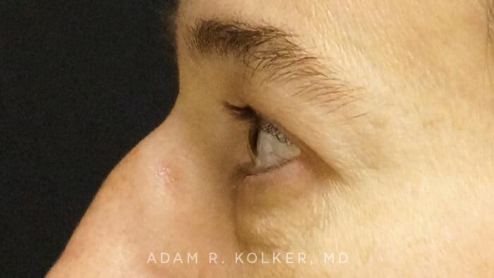 Blepharoplasty Before Image Patient 04 Side View