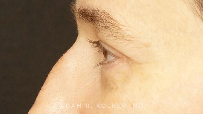 Blepharoplasty After Image Patient 04 Side View