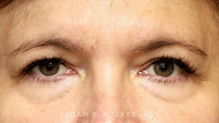 Blepharoplasty Before Image Patient 05 Front View