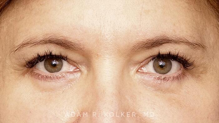 Blepharoplasty After Image Patient 05 Front View