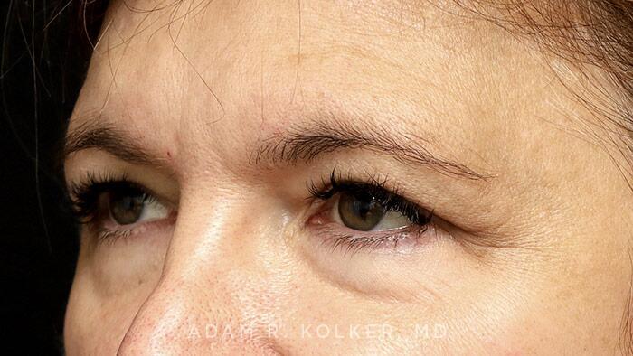Blepharoplasty Before Image Patient 05 Oblique View