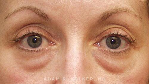 Blepharoplasty Before Image Patient 06 Front View