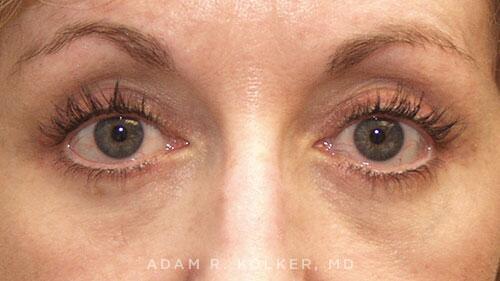 Blepharoplasty After Image Patient 06 Front View