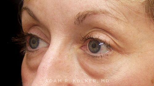 Blepharoplasty Before Image Patient 06 Oblique View