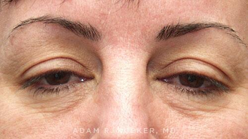 Blepharoplasty Before Image Patient 07 Front View