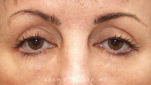 Blepharoplasty After Image Patient 07 Front View