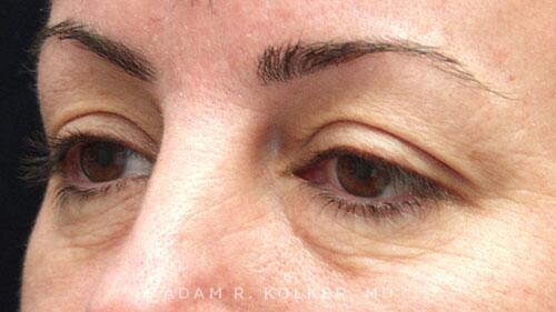 Blepharoplasty Before Image Patient 07 Oblique View