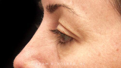 Blepharoplasty Before Image Patient 07 Side View
