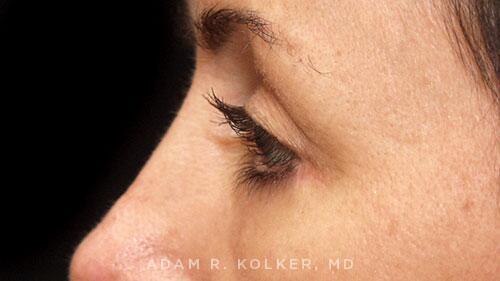 Blepharoplasty After Image Patient 07 Side View